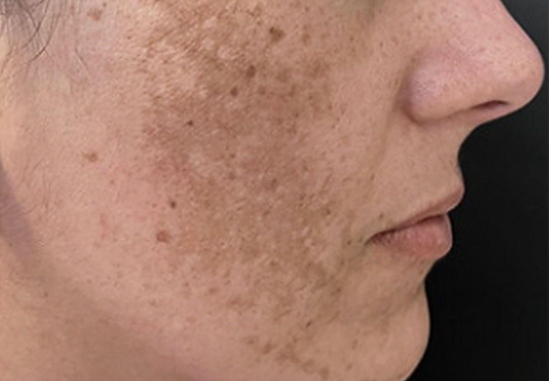 Paciente com melasma malar, vista lateral do rosto